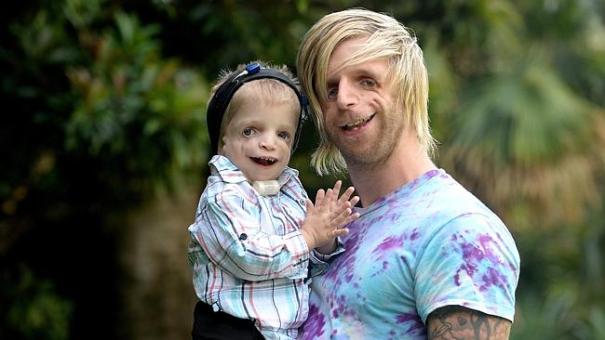 Zackary Walton and Jono Lancaster - Treacher Collins Syndrome